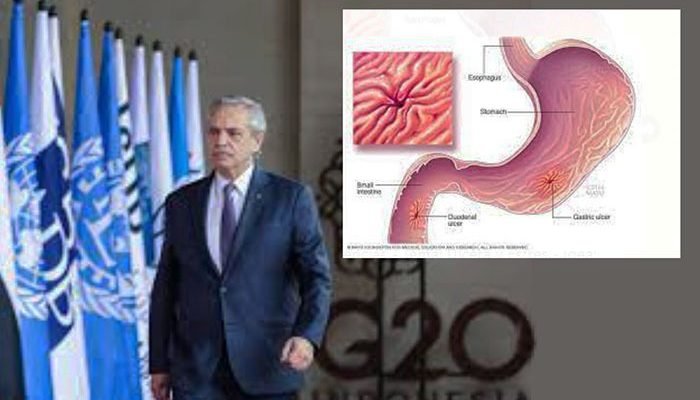 Las Úlceras las Provoca el Estrés